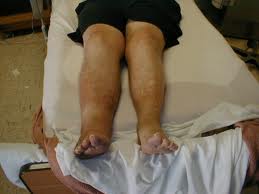 What does Diabetes leg swelling mean? Possibly the loss of the leg