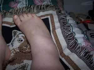Swelling Legs from diabetes is a very serious problem