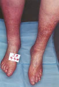 Diabetes Leg swelling can be from the Drugs or The illness, it can cost you the leg.