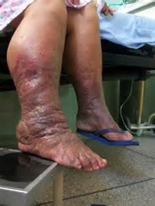 Swelling in the lower limb from diabetes can cause the loss of the leg